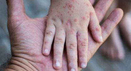 ¿Qué tan grave es el sarampión para los niños?